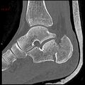 Calcaneal fracture and associated spinal injury (Radiopaedia 17896-17656 Sagittal bone window 1).jpg