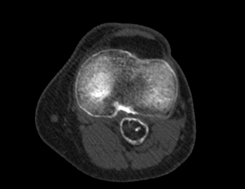 Calcified hematoma - popliteal fossa (Radiopaedia 63938-72763 Axial bone window 37).jpg