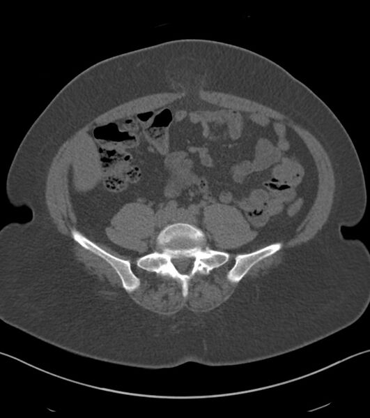 File:Calcified hepatic hydatid cyst (Radiopaedia 81127-94738 Axial non-contrast 67).jpg