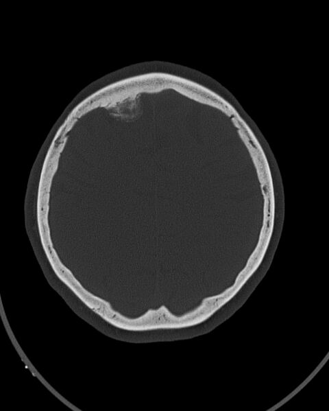 File:Calcified meningioma (Radiopaedia 74361-85243 Axial bone window 10).jpg