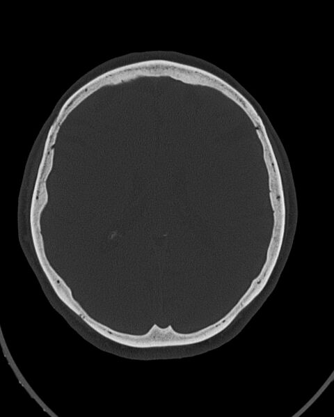 File:Calcified meningioma (Radiopaedia 74361-85243 Axial bone window 21).jpg