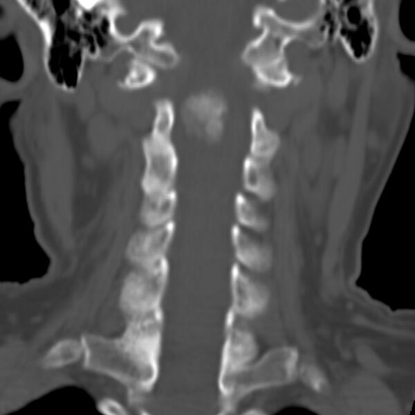 File:Calcified meningioma - cervical canal (Radiopaedia 70136-80171 Coronal bone window 14).jpg