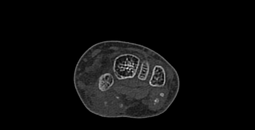 Calcifying aponeurotic fibroma (Radiopaedia 88423-105064 Axial bone window 76).jpg