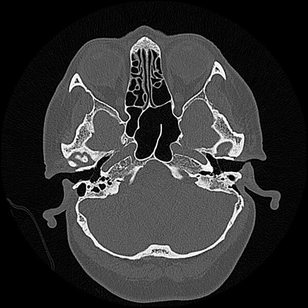 File:Canal up mastoidectomy (Radiopaedia 78108-90638 Axial bone window 56).jpg