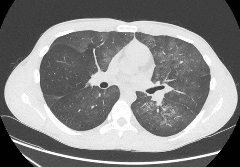 File:Cannabis-induced diffuse alveolar hemorrhage (Radiopaedia 89834-106946 Axial lung window 54).jpg