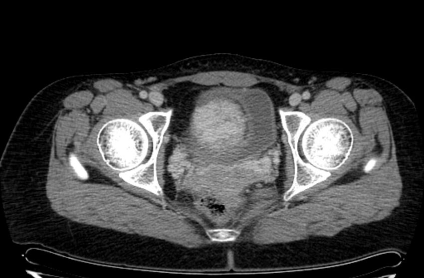 Cannonball metastases - uterine choriocarcinoma (Radiopaedia 70137-80174 A 47).jpg