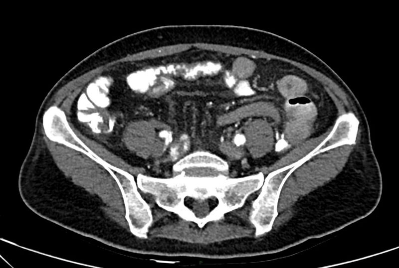 File:Carcinoid mesenteric tumor complicated by chylous ascites (Radiopaedia 76312-88926 A 51).jpg