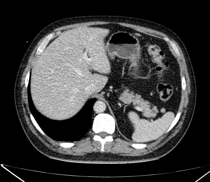 File:Carcinoid tumor with hepatic metastases (Radiopaedia 22651-22670 C 33).jpg