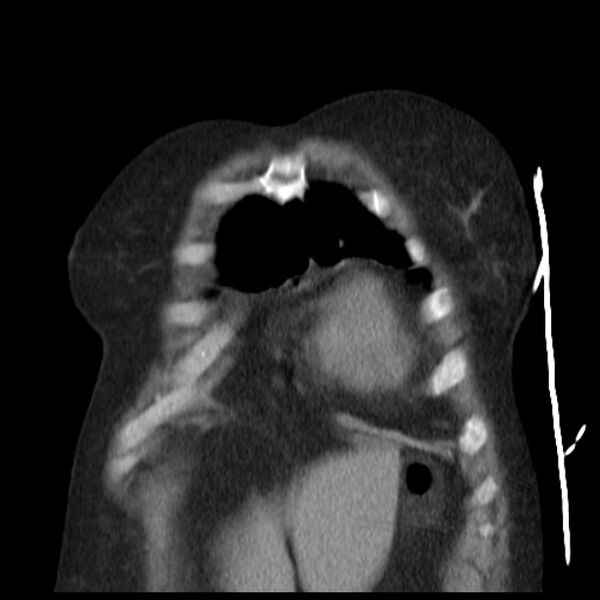 File:Cardiogenic pulmonary edema (Radiopaedia 29213-29609 Coronal non-contrast 4).jpg