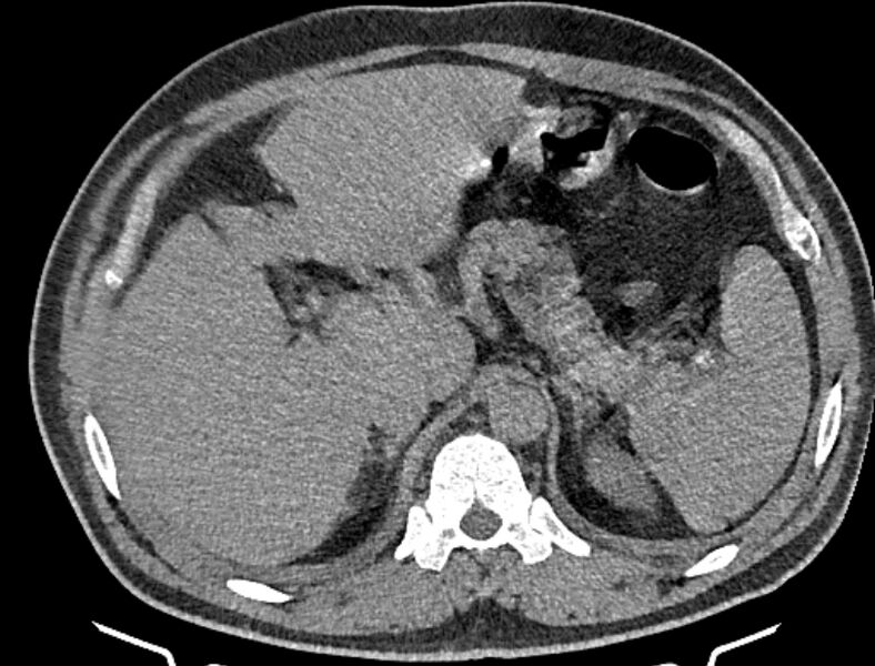 File:Cardiogenic pulmonary edema (Radiopaedia 68180-77678 Axial non-contrast 62).jpg
