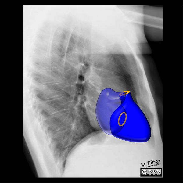 File:Cardiomediastinal anatomy on chest radiography (annotated images) (Radiopaedia 46331-50748 E 1).png