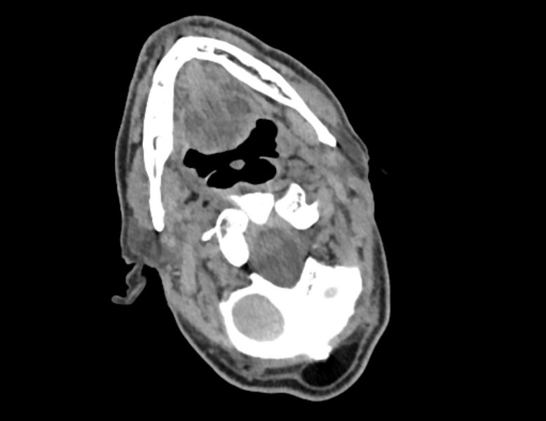 File:Carotid artery pseudoaneurysm (Radiopaedia 84030-99259 Axial non-contrast 5).jpg