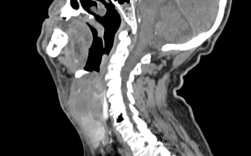 Carotid artery pseudoaneurysm (Radiopaedia 84030-99259 E 13).jpg