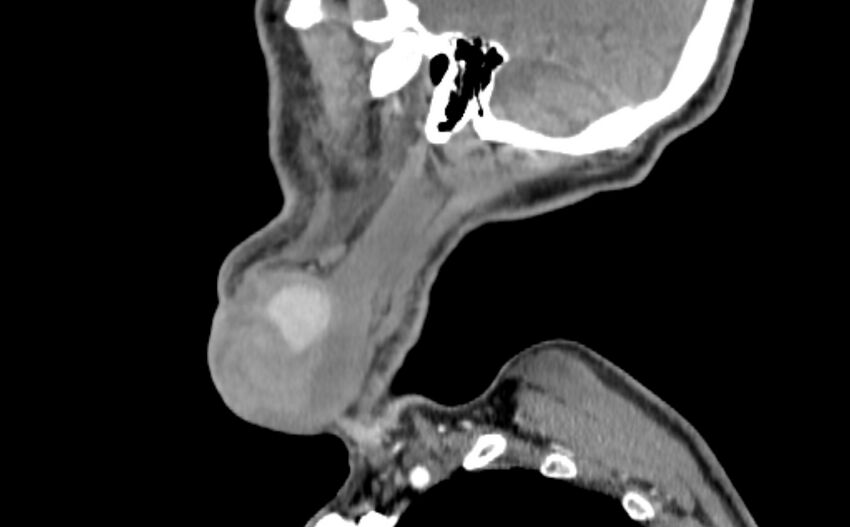 Carotid artery pseudoaneurysm (Radiopaedia 84030-99259 E 55).jpg