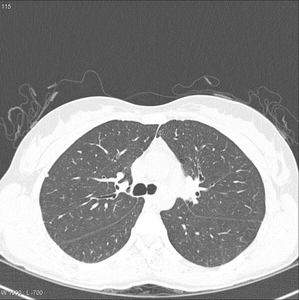 File:Catamenial pneumothorax (Radiopaedia 24847-25111 Axial lung window 1).jpg