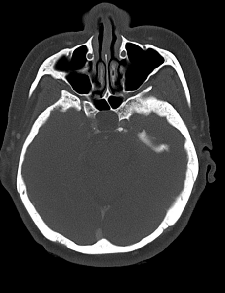 File:Causes of dysphagia (Radiopaedia 40149-42657 Axial bone window 2).png