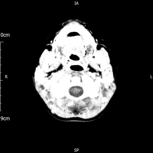 File:Cavernous sinus thrombosis (Radiopaedia 79414-92510 Axial Brain 38).jpg