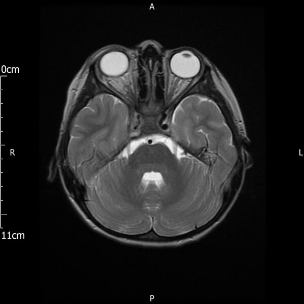 File:Cavernous sinus thrombosis (Radiopaedia 79414-92512 Axial T2 9).jpg
