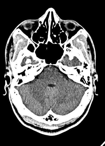 File:Cavum septum pellucidum and cavum vergae (Radiopaedia 77797-90060 Axial Brain Window 26).jpg