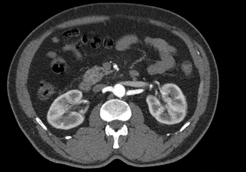 File:Celiac artery dissection (Radiopaedia 52194-58080 A 43).jpg