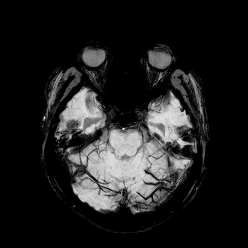 Central neurocytoma (Radiopaedia 79320-92380 Axial SWI 42).jpg