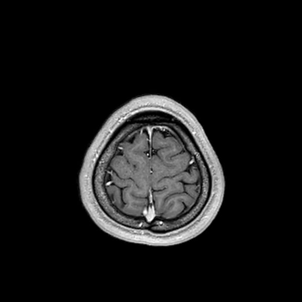 File:Central neurocytoma (Radiopaedia 79320-92380 Axial T1 C+ 209).jpg