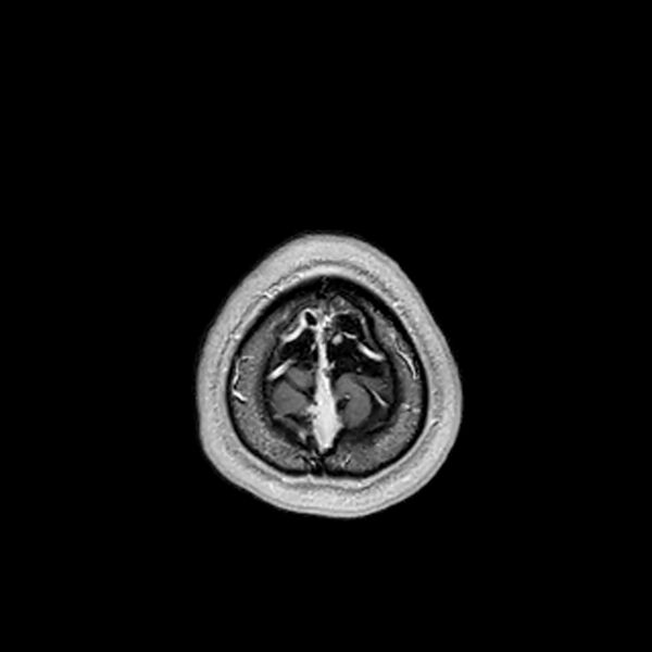 File:Central neurocytoma (Radiopaedia 79320-92380 Axial T1 C+ 219).jpg