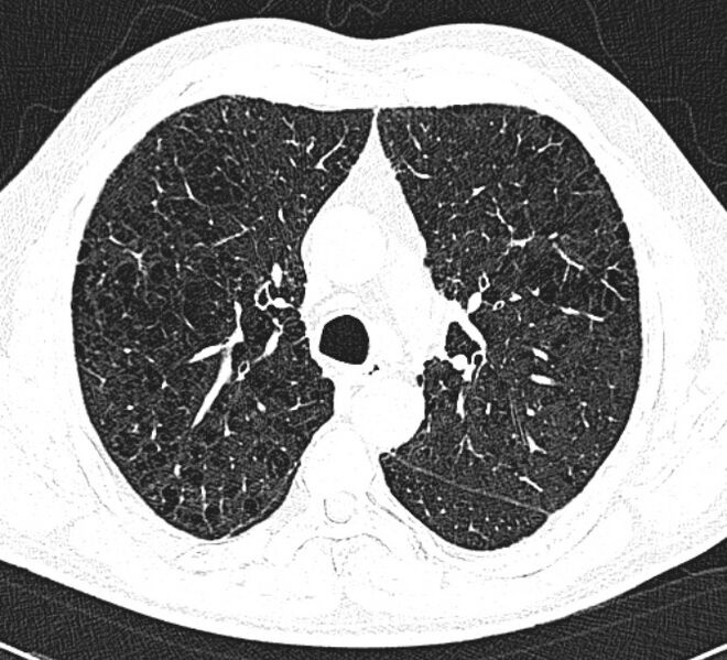 File:Centrilobular pulmonary emphysema (Radiopaedia 26808-26971 Axial lung window 15).jpg