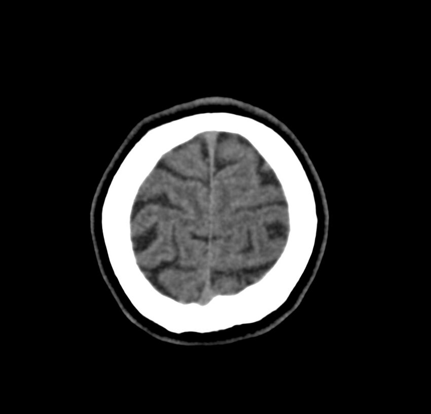 Cerebellar agenesis (Radiopaedia 30203-30817 Axial non-contrast 46).jpg