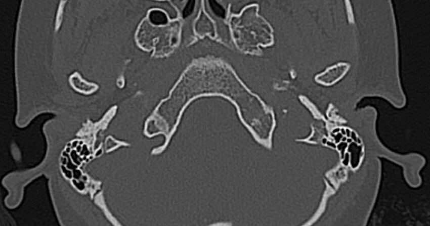 Cerebellopontine angle lipoma (Radiopaedia 57303-64242 Axial bone window 5).jpg