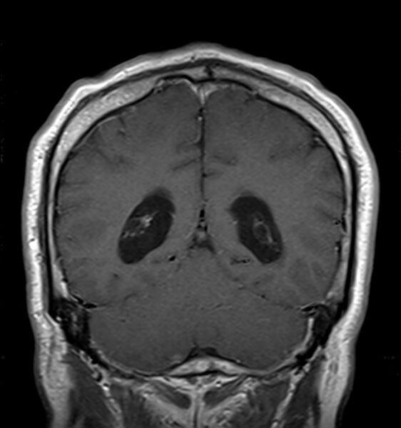File:Cerebellopontine angle meningioma (Radiopaedia 24459-24764 Coronal T1 C+ 18).jpg