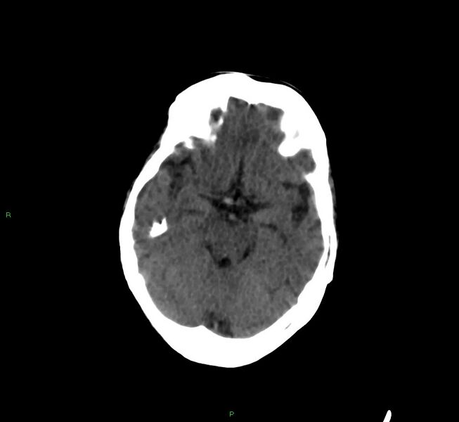 File:Cerebral amyloid angiopathy-associated lobar intracerebral hemorrhage (Radiopaedia 58377-65514 Axial non-contrast 33).jpg