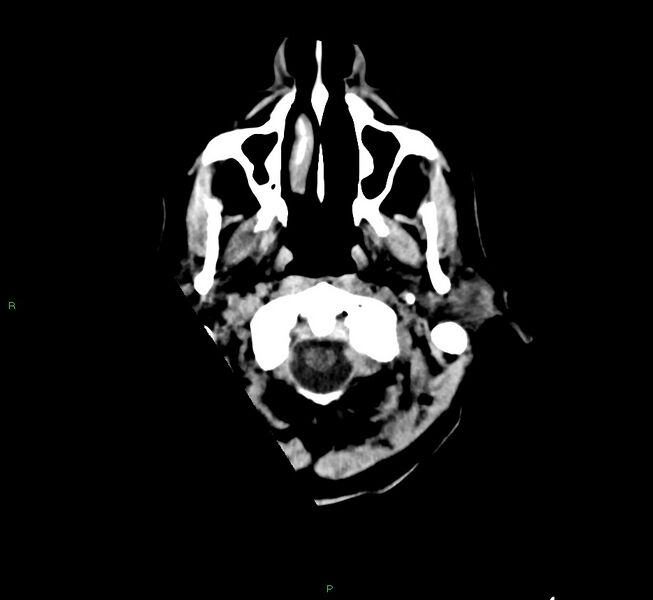 File:Cerebral amyloid angiopathy-associated lobar intracerebral hemorrhage (Radiopaedia 58529-65681 Axial non-contrast 51).jpg