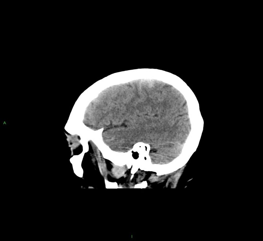 Cerebral amyloid angiopathy-associated lobar intracerebral hemorrhage (Radiopaedia 58529-65681 B 39).jpg