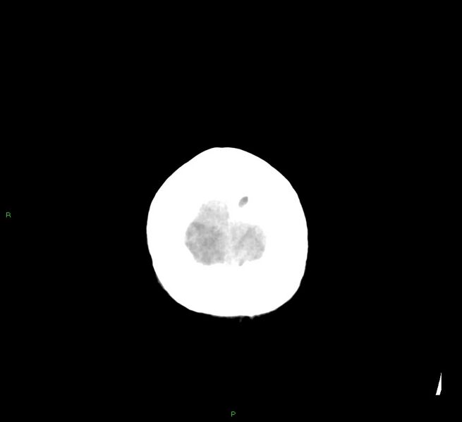 File:Cerebral amyloid angiopathy-associated lobar intracerebral hemorrhage (Radiopaedia 58529-65687 Axial non-contrast 5).jpg