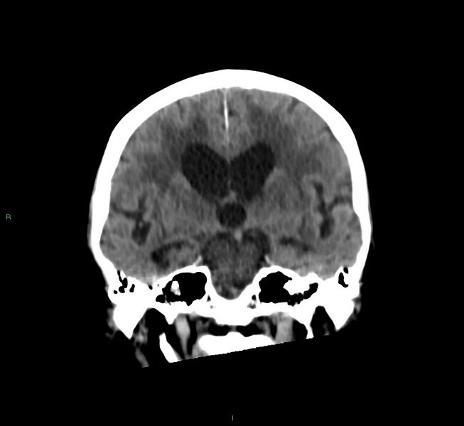 File:Cerebral amyloid angiopathy-associated lobar intracerebral hemorrhage (Radiopaedia 58530-65688 Coronal non-contrast 37).jpg