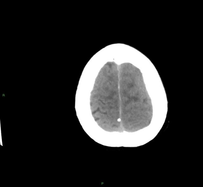 File:Cerebral amyloid angiopathy-associated lobar intracerebral hemorrhage (Radiopaedia 58561-65724 Axial non-contrast 5).jpg