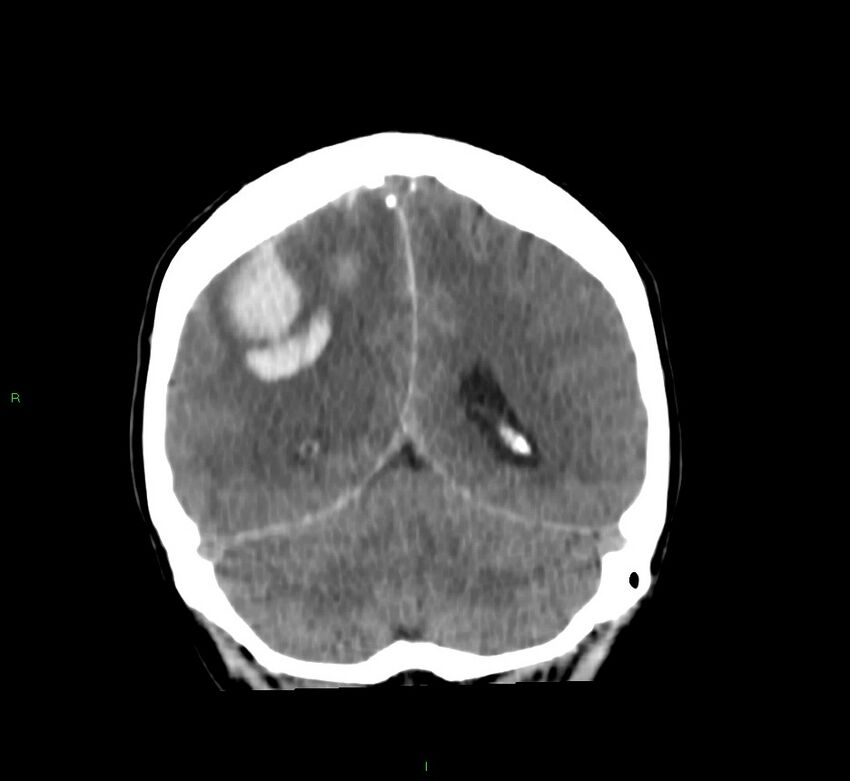 Cerebral amyloid angiopathy-associated lobar intracerebral hemorrhage (Radiopaedia 58756-65977 Coronal non-contrast 23).jpg