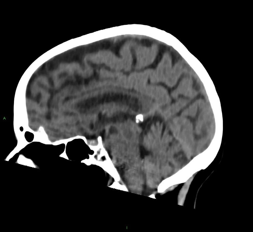 Cerebral amyloid angiopathy-associated lobar intracerebral hemorrhage (Radiopaedia 58757-65978 C 27).jpg
