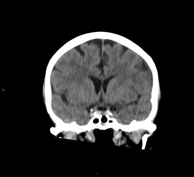 File:Cerebral amyloid angiopathy-associated lobar intracerebral hemorrhage (Radiopaedia 58757-65978 Coronal non-contrast 42).jpg