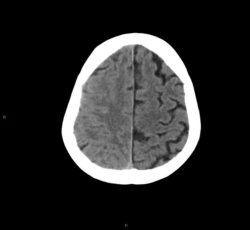 Cerebral amyloid angiopathy-associated lobar intracerebral hemorrhage (Radiopaedia 58758-65980 Axial non-contrast 12).jpg