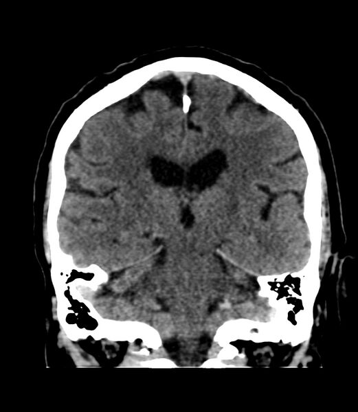 File:Cerebral dural venous sinus thrombosis (Radiopaedia 86514-102575 Coronal non-contrast 29).jpg