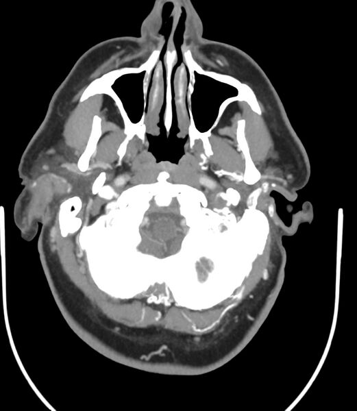 File:Cerebral dural venous sinus thrombosis (Radiopaedia 86514-102576 A 24).jpg