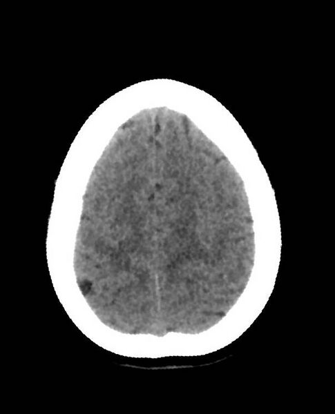 File:Cerebral edema due to severe hyponatremia (Radiopaedia 89826-106938 Axial non-contrast 85).jpg