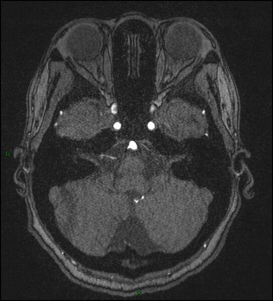File:Cerebral fat embolism (Radiopaedia 35022-36525 Axial TOF 42).jpg
