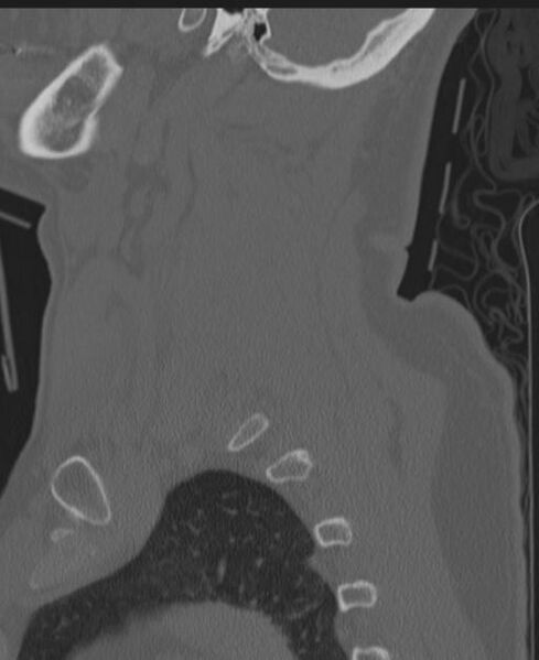 File:Cerebral hemorrhagic contusions and cervical spine fractures (Radiopaedia 32865-33841 Sagittal bone window 24).jpg