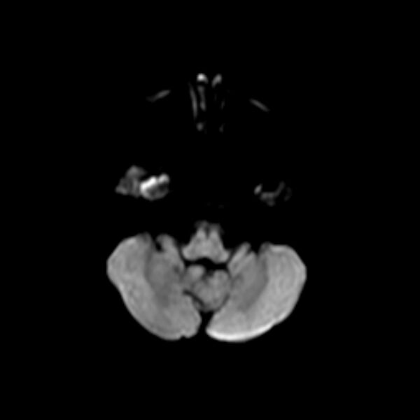 File:Cerebral tuberculoma (Radiopaedia 41152-43932 Axial DWI 2).jpg
