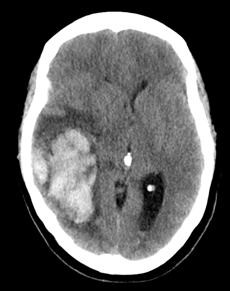 File:Cerebral venous infarct related to dural venous sinus thromboses (Radiopaedia 35292-36803 AXIAL THICK 13).png