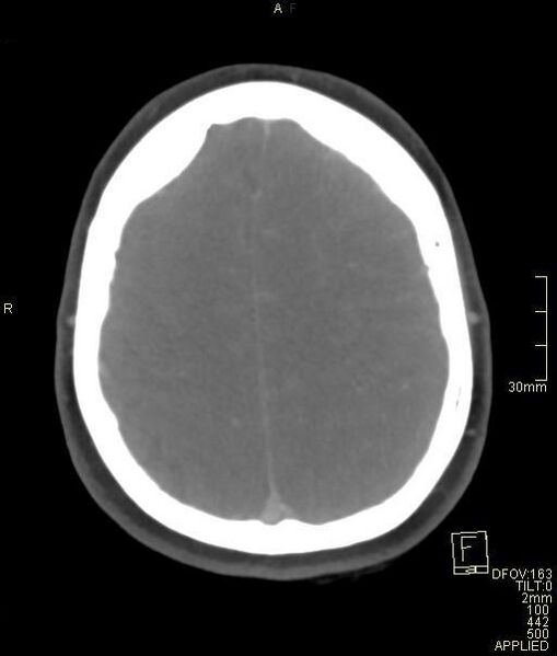 File:Cerebral venous sinus thrombosis (Radiopaedia 91329-108965 Axial venogram 64).jpg