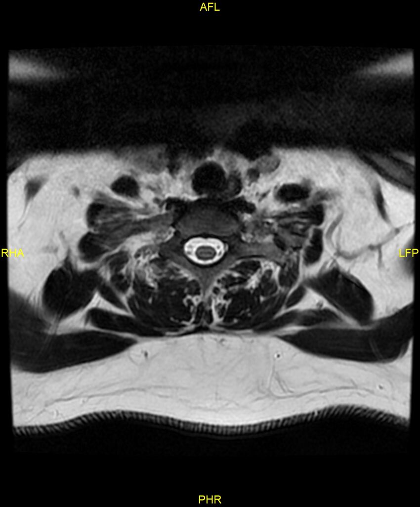 Cervical disc protrusion (Radiopaedia 87147-103415 Axial T2 72).jpg